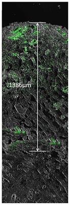 Comparison of the effects of negative pressure wound therapy and negative pressure wound therapy with instillation on wound healing in a porcine model